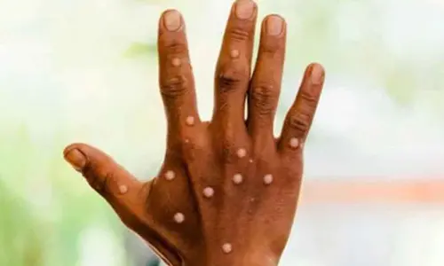 WHO steps up mpox surveillance in South Sudan as cases surge in Africa