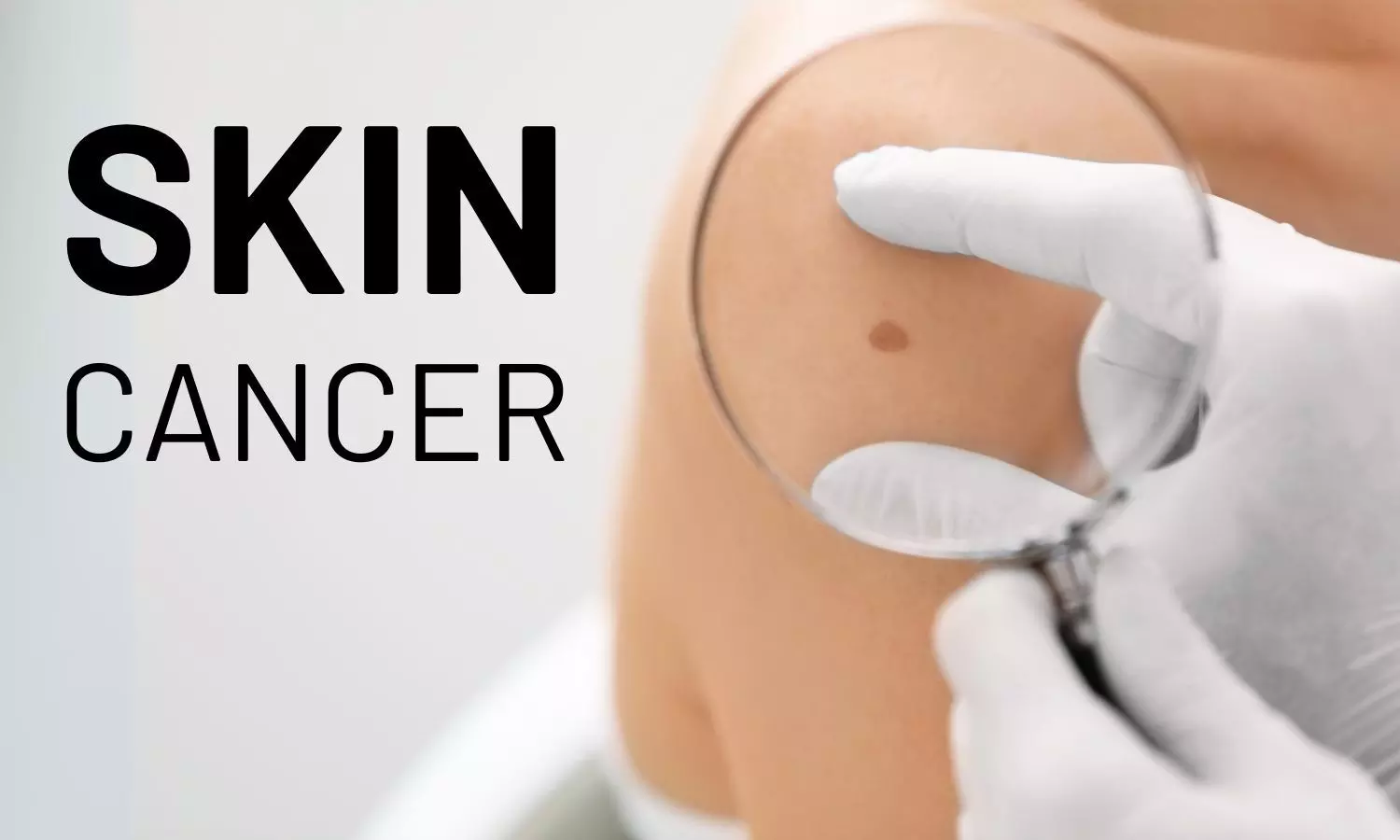 Skin Cancer: Understanding Risk Factors and Treatment Options