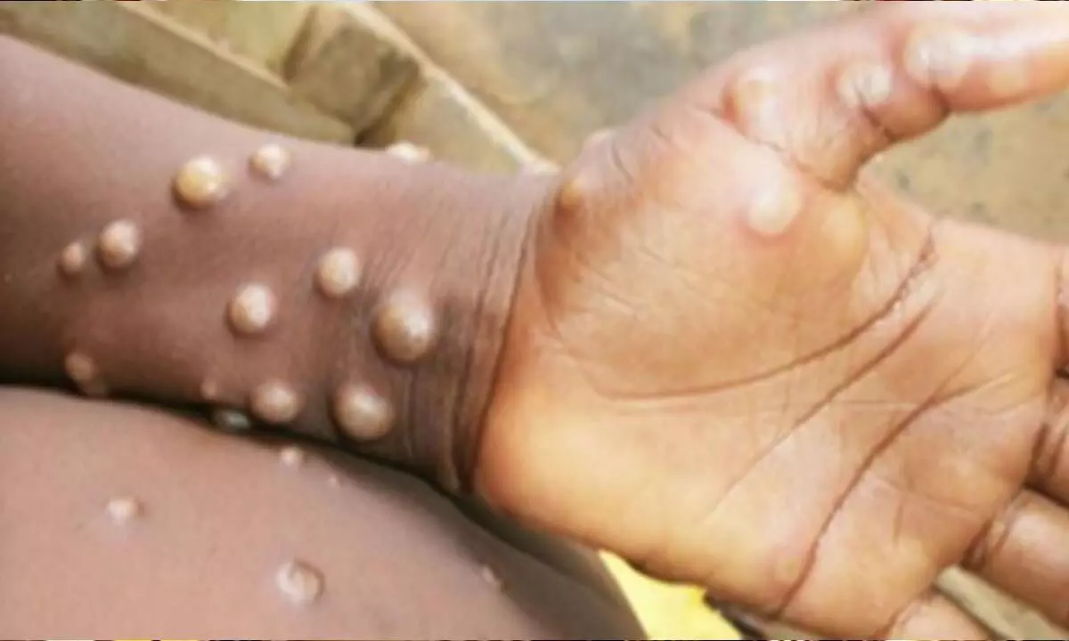 Kenyas mpox cases rise to seven