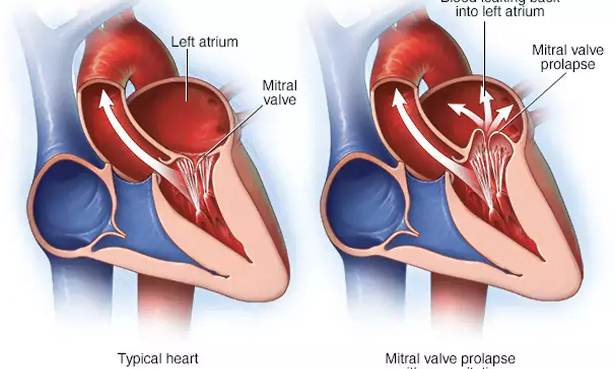 25-yr-old African woman battling severely leaking and narrowed heart valves treated