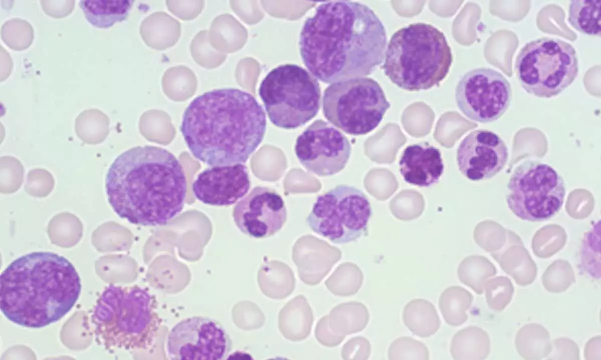 How targeted therapies are boosting outcomes for bone marrow cancer