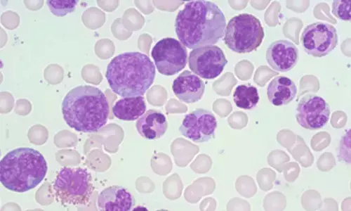 How targeted therapies are boosting outcomes for bone marrow cancer