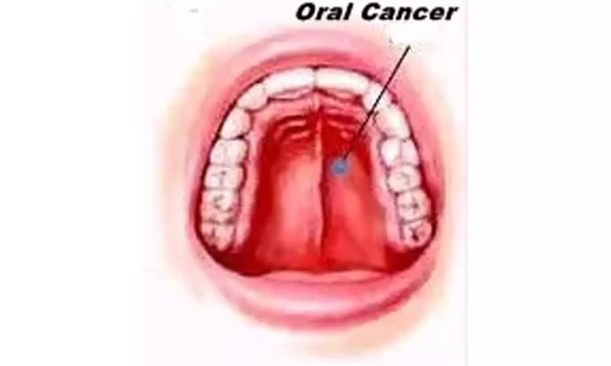 Smokeless tobacco, betel nut drive oral cancer cases in India, highest in South Asia: Lancet