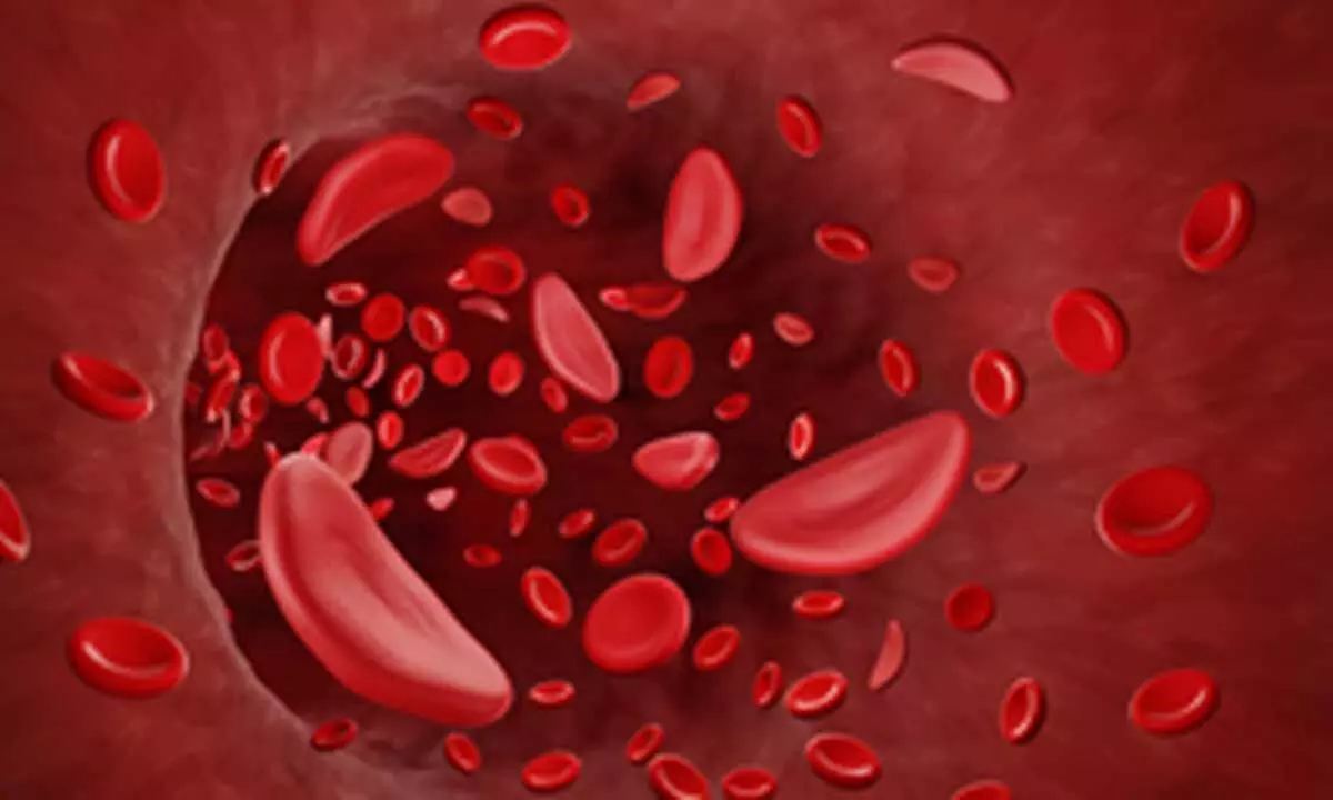 ICMR, Zydus tie up for clinical trial to combat sickle cell disease