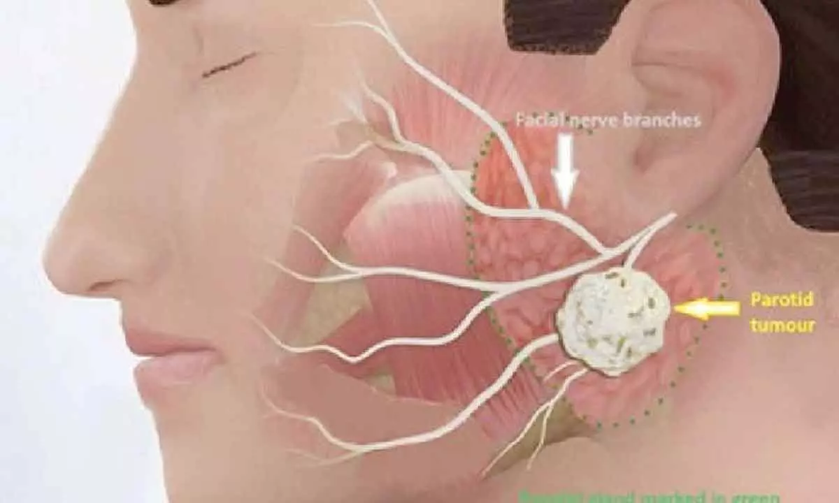 Massive complex neck tumour weighing 523 gm successfully removed