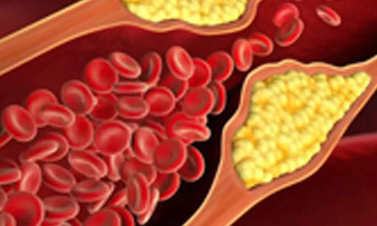 Covid infection spiked high cholesterol risk by 30pc: Study