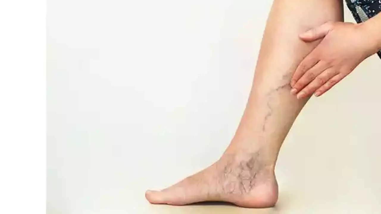 25% Indians affected by varicose veins