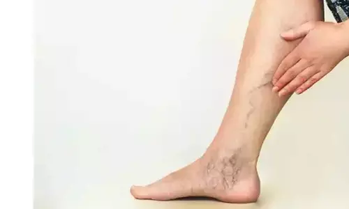 25% Indians affected by varicose veins