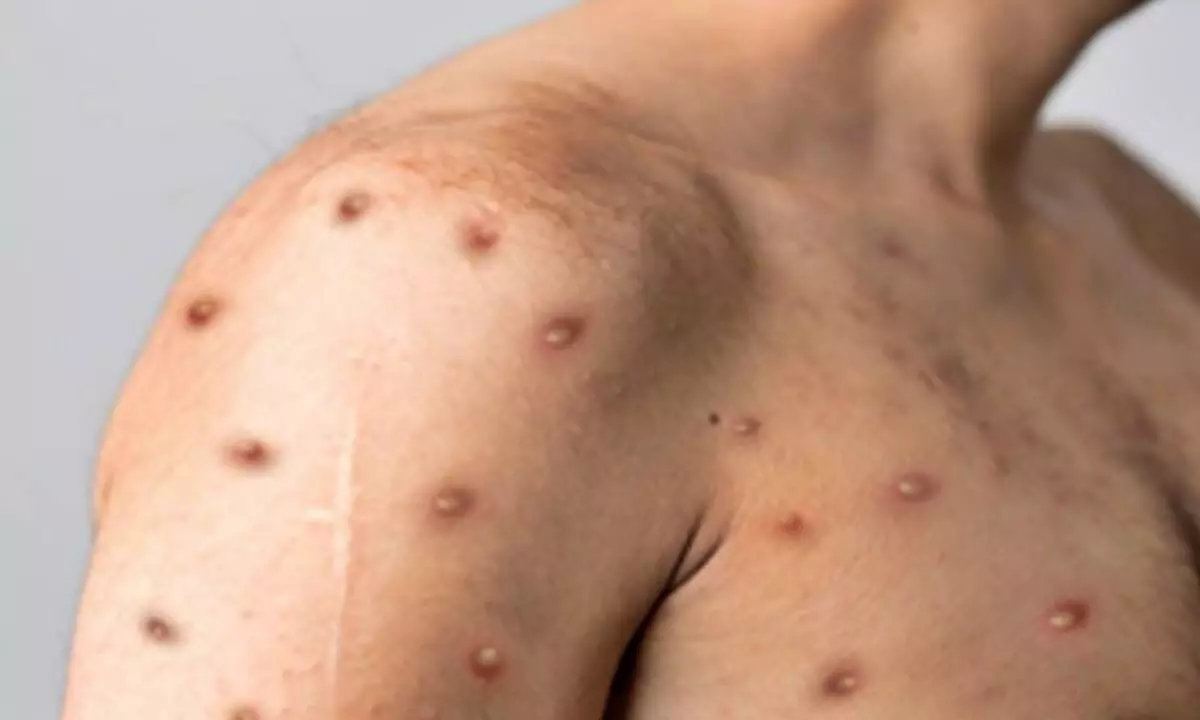 US confirms first case of clade I mpox in California