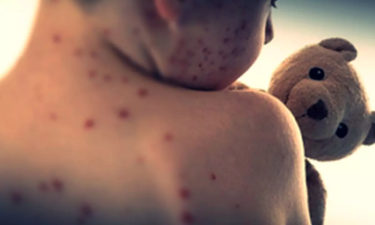 Vietnams Ho Chi Minh City reports surging measles infections among children