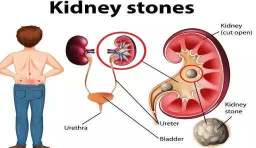 Top Causes of Kidney Stones and How to Recognize Silent Symptoms