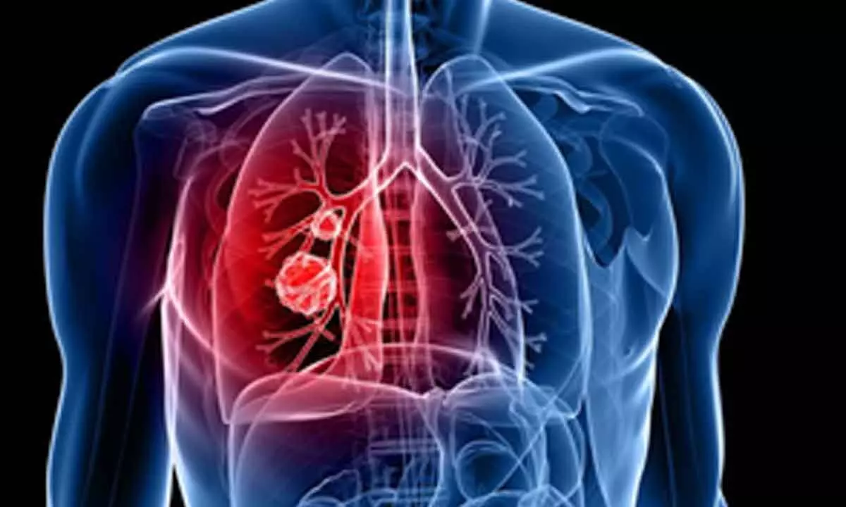 Doctors raise concern over rising lung cancers among non-smokers in India