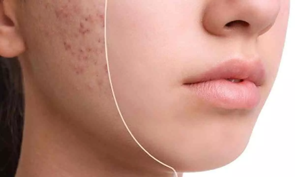 Natural Remedies to Reduce Acne Marks Effectively