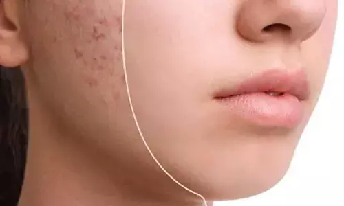 Natural Remedies to Reduce Acne Marks Effectively