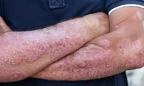 Global prevalence of atopic dermatitis to reach 42.42 mn by 2033: Report