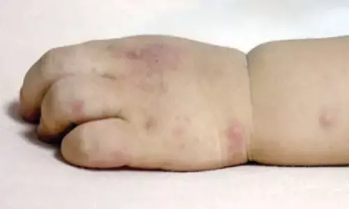 Paediatricians raise alarm over spread of HFMD in Prakasam