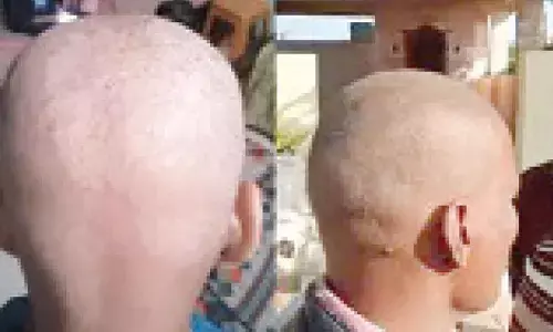 Villagers in Maha face sudden hair loss