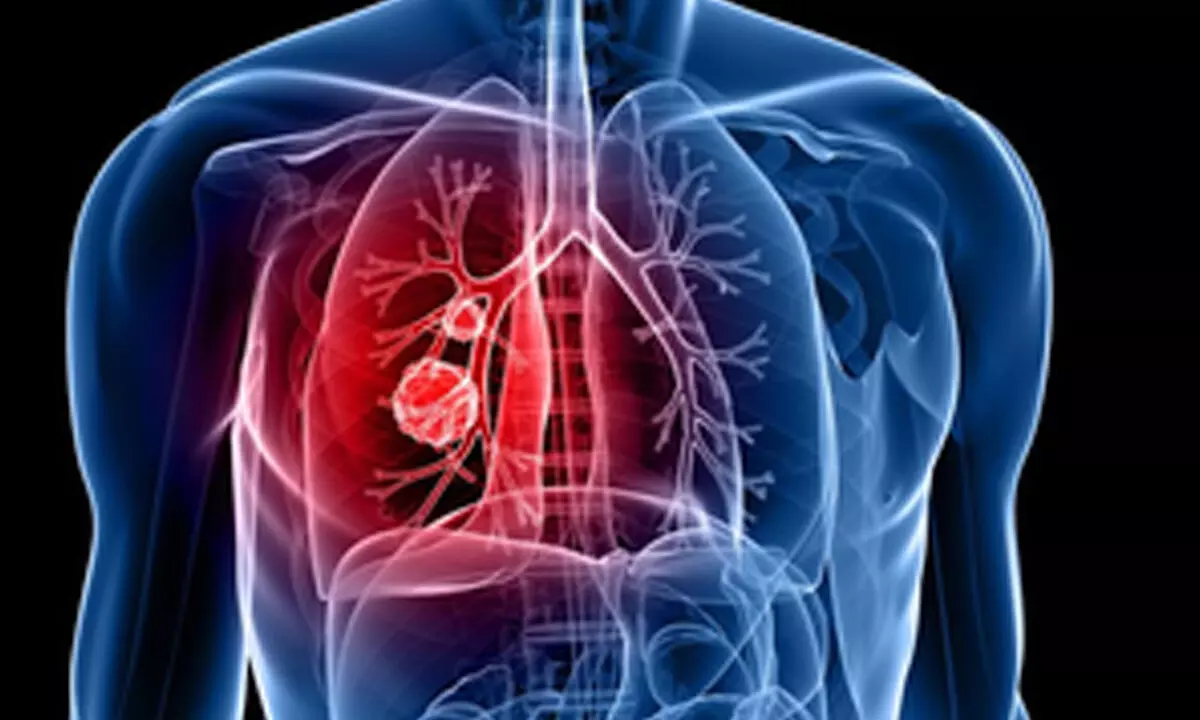 Study shows tumour DNA in blood can predict lung cancer outcome