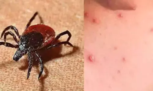 TN Health Department on high alert as scrub typhus cases rise