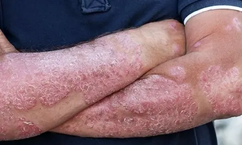 Combination immunotherapy may cure patients with deadly advanced skin cancer