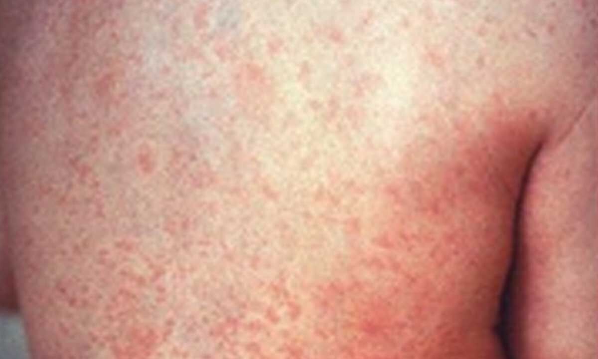 Mongolia confirms imported case of measles