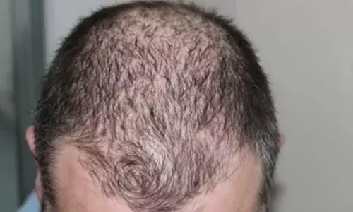 Study shows low doses of antibiotics can help treat a rare hair loss problem