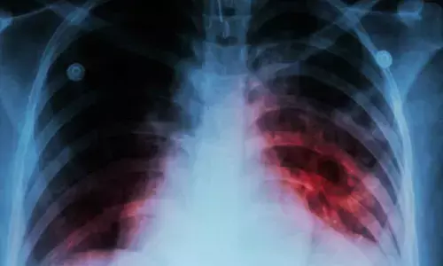 Singapore reports 1,156 new tuberculosis cases in 2024, lower than 2023
