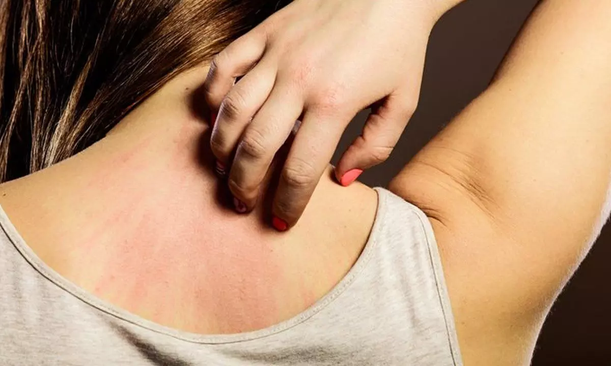 Natural and Easy Home Remedies to Soothe Rashes and Itchy Skin