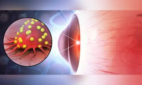 Study shows new drug delivery system effective against rare eye cancer