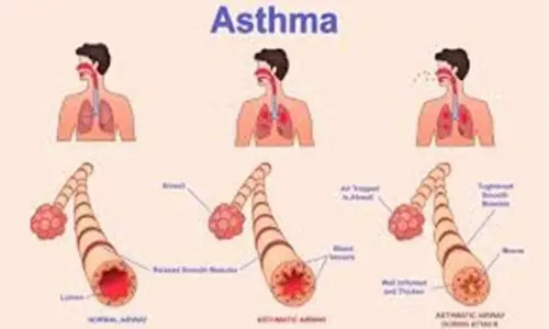 Understanding Bronchial Spasms: Causes, Symptoms, and Remedies