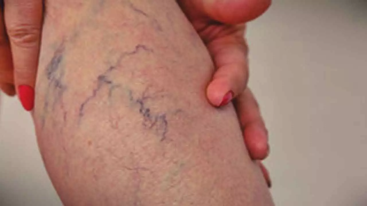 Ice-cold feet and heaviness in legs? It may signal varicose veins, says study Ice-cold feet and heaviness in legs? It may signal varicose veins, says study