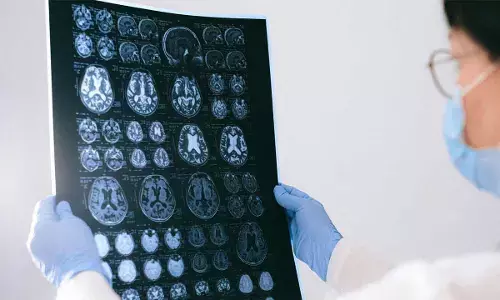Brains of people with schizophrenia may age faster