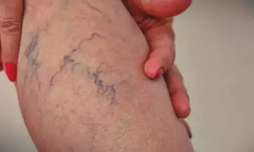 Ice-cold feet and heaviness in legs? It may signal varicose veins, says study