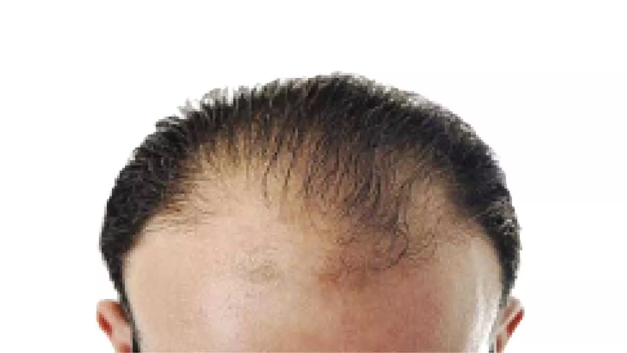 Hair-raising: Hundreds fall prey to bald cure con in city Hair-raising: Hundreds fall prey to bald cure con in city