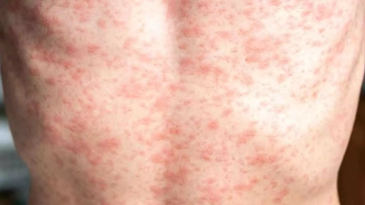 US faces resurgence of measles cases as vaccination rates decline: Study US faces resurgence of measles cases as vaccination rates decline: Study