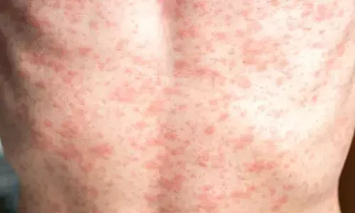 US faces resurgence of measles cases as vaccination rates decline: Study