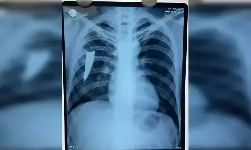 Broken knife removed from man’s lungs in MKCG