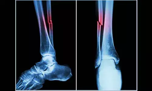 New machine algorithm can identify heart, fracture risks with routine bone scans