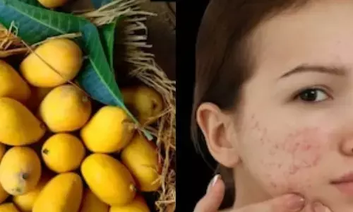 Do Mangoes Really Cause Pimples? Heres the Truth Behind the Myth