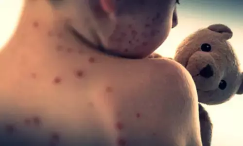 Mongolias total number of confirmed measles cases exceeds 3,000