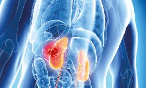 Early screening helps city resident get timely treatment for kidney cancer