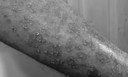 Early exposure to pet dogs may lower kids risk of eczema: Study