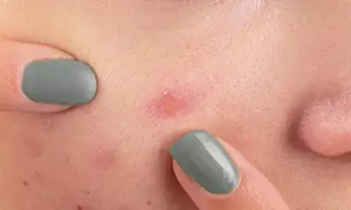 Say Goodbye to Pimples Naturally: Home Remedies to Eliminate Pimples