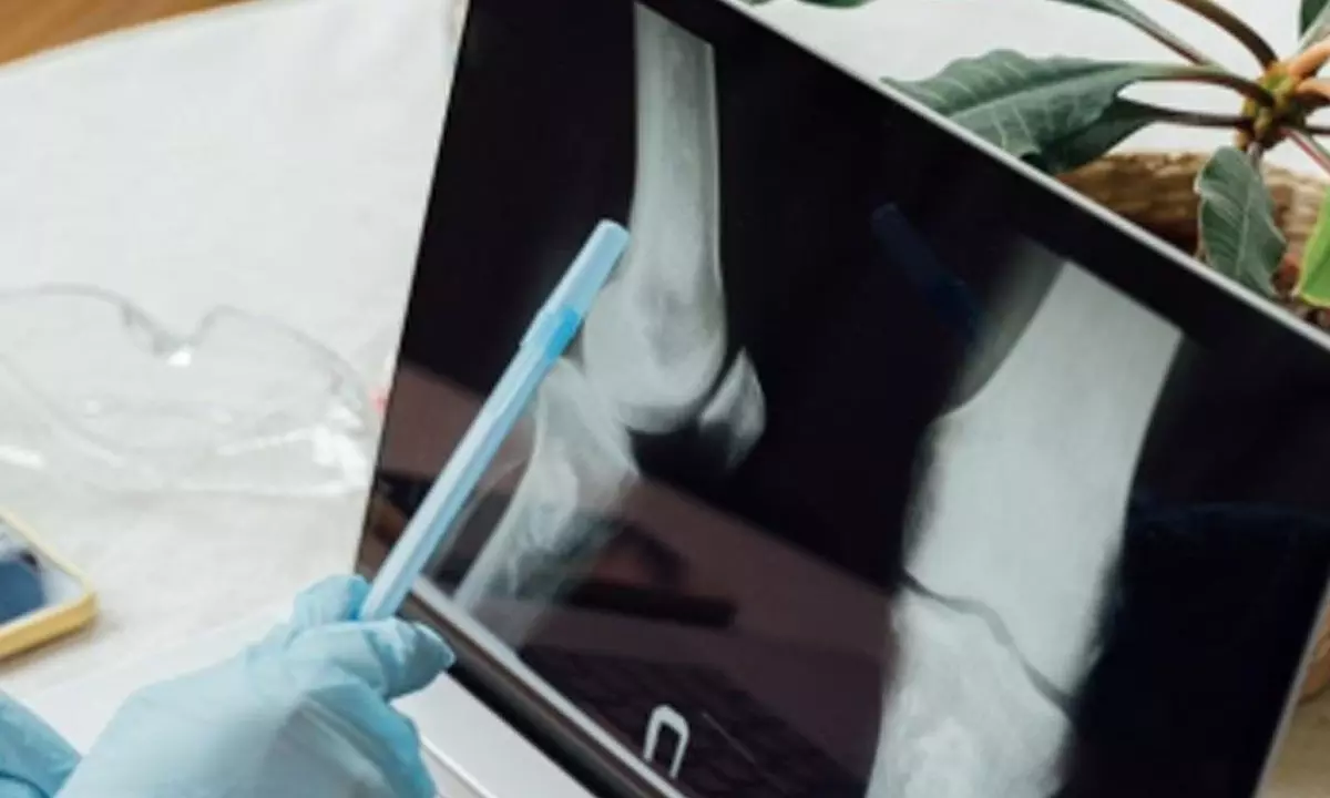 Indian researchers develop diagnostic device to detect early-stage bone cancer