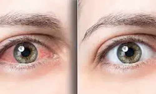 Can Rose Water Help Relieve Dry and Itchy Eyes Naturally?