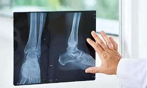 Researchers develop diagnostic device to detect early-stage bone cancer