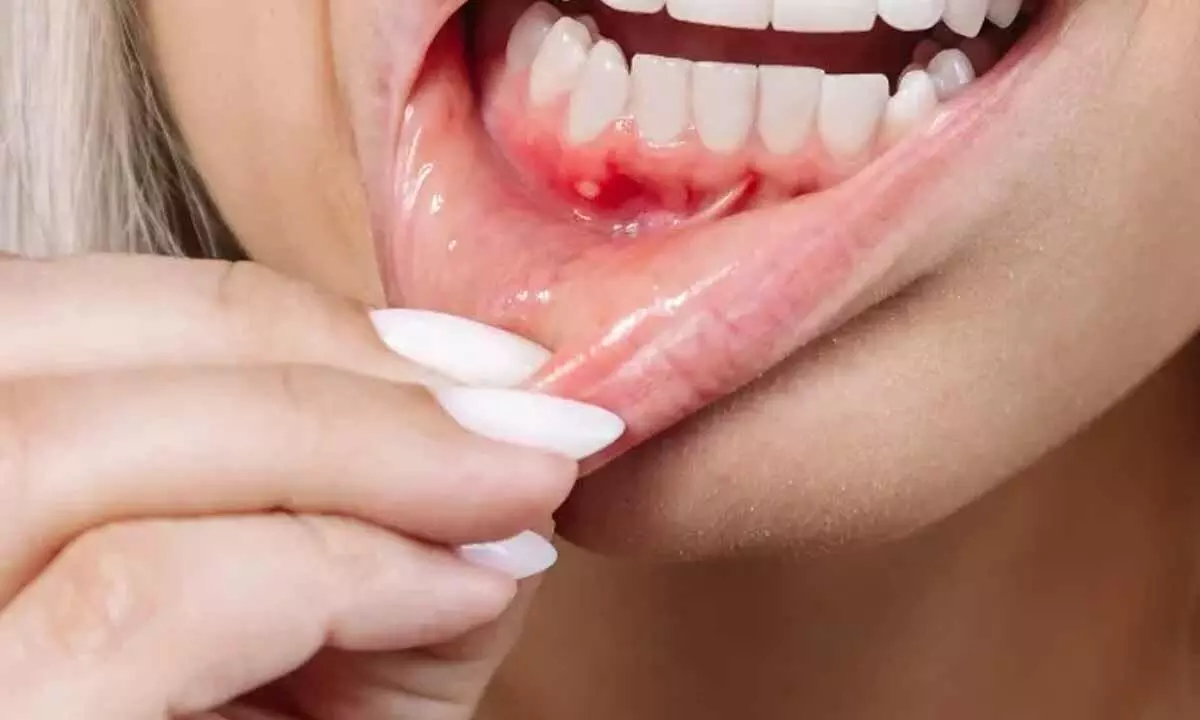 Healing Mouth Ulcers Naturally: Simple Remedies for Lasting Relief