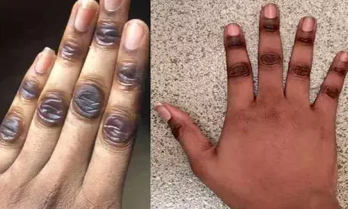 Natural DIY Remedies to Lighten Dark Knuckles at Home