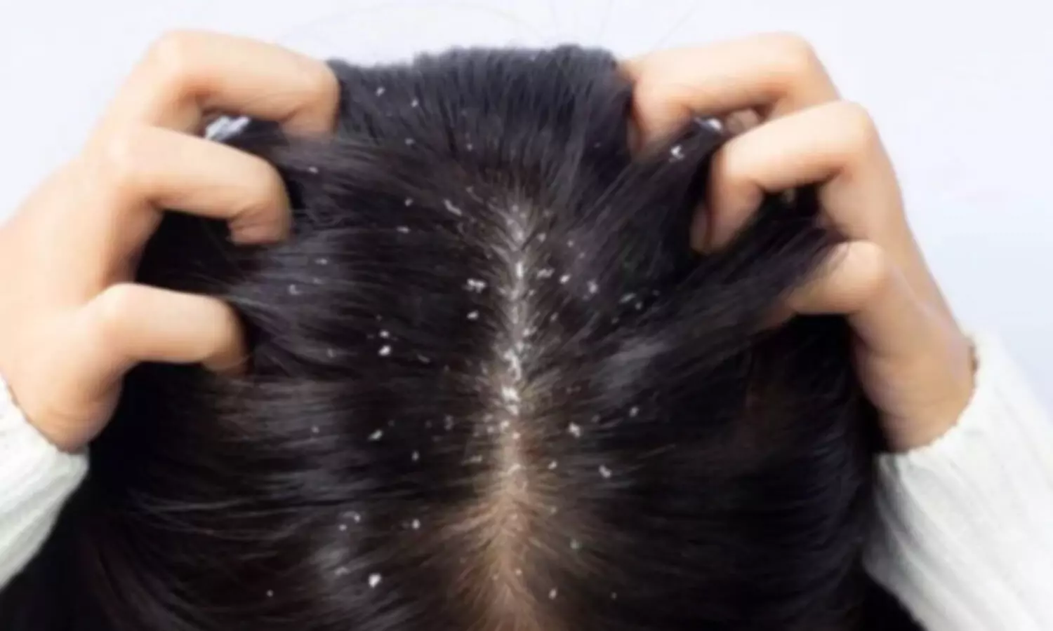 Natural DIY Remedies to Banish Dandruff This Monsoon Natural DIY Remedies to Banish Dandruff This Monsoon