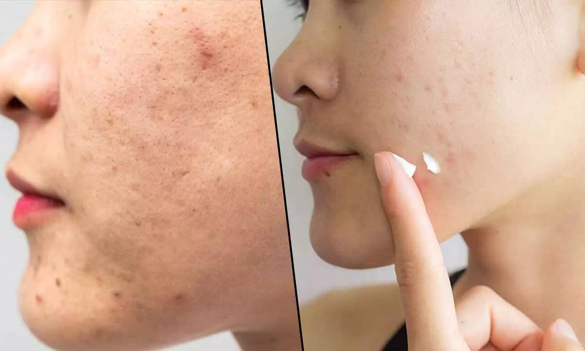 How to Prevent Clogged Pores and Breakouts Naturally